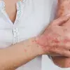 What are the benefits and risks of systemic treatments for psoriasis ?