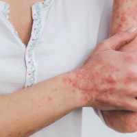 Quels sont les bénéfices et les risques des traitements systémiques du psoriasis ?